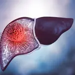 Rastreamento de Carcinoma Hepatocelular: Como Fazer?