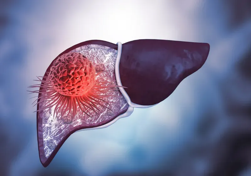 Rastreamento de Carcinoma Hepatocelular: Como Fazer?