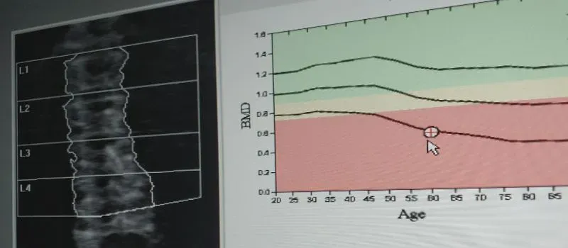 Tratamento da Osteoporose Primária