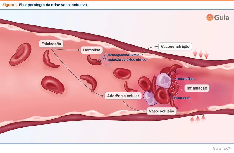 Fisiopatologia da crise vaso-oclusiva