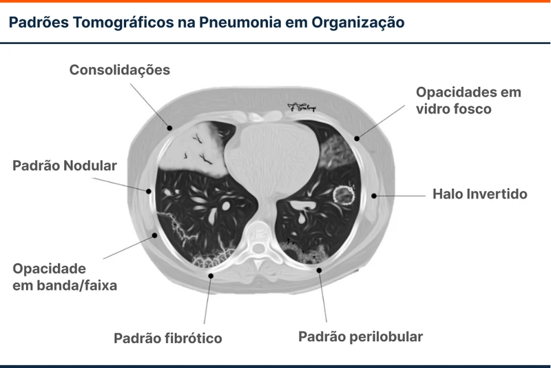 Padrões Tomográficos na Pneumonia em Organização