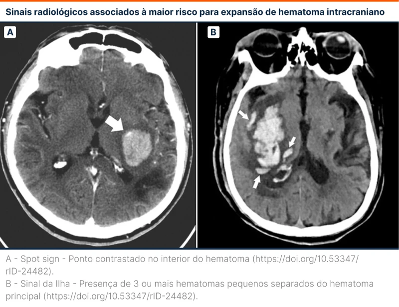 Sinais radiológicos associados à maior risco para expansão de hematoma intracraniano