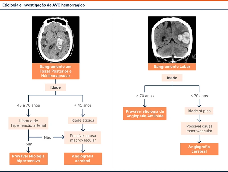 Etiologia e investigação de AVC hemorrágico