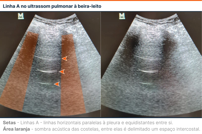 Linha A no ultrassom pulmonar à beira-leito