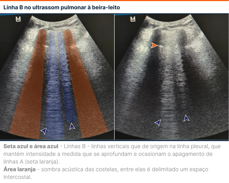 Linha B no ultrassom pulmonar à beira-leito