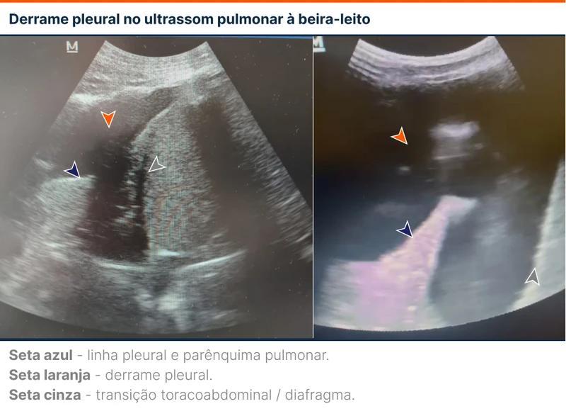 Derrame pleural no ultrassom pulmonar à beira-leito