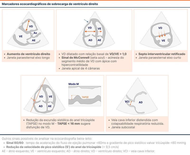 Marcadores ecocardiográficos de sobrecarga de ventrículo direito
