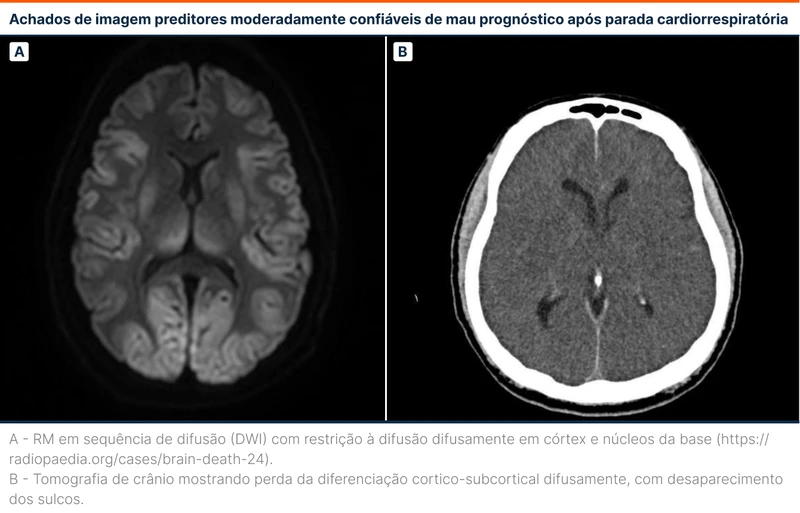 Achados de imagem preditores moderadamente confiáveis de mau prognóstico após parada cardiorrespiratória