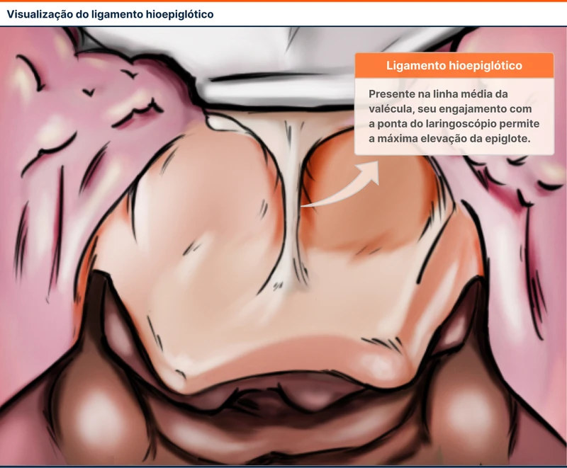 Visualização do ligamento hioepiglótico