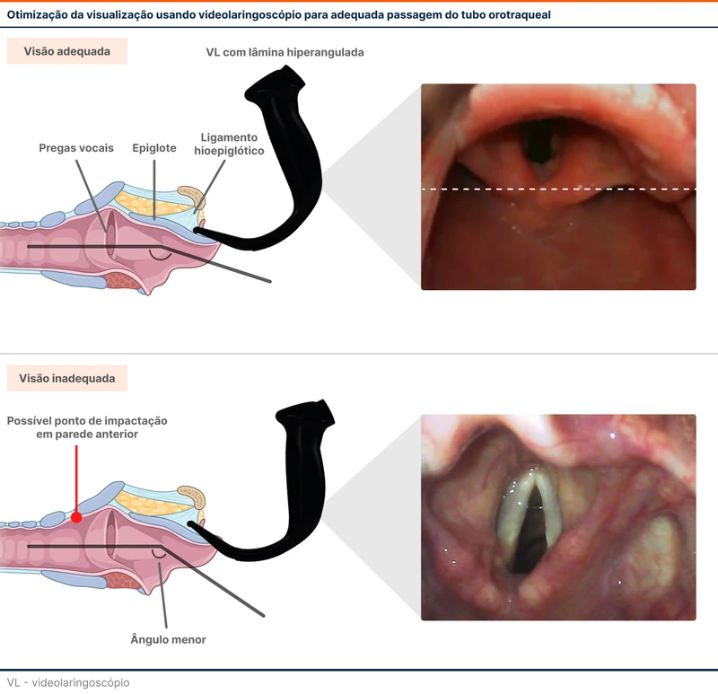 Otimização da visualização usando videolaringoscópio para adequada passagem do tubo orotraqueal