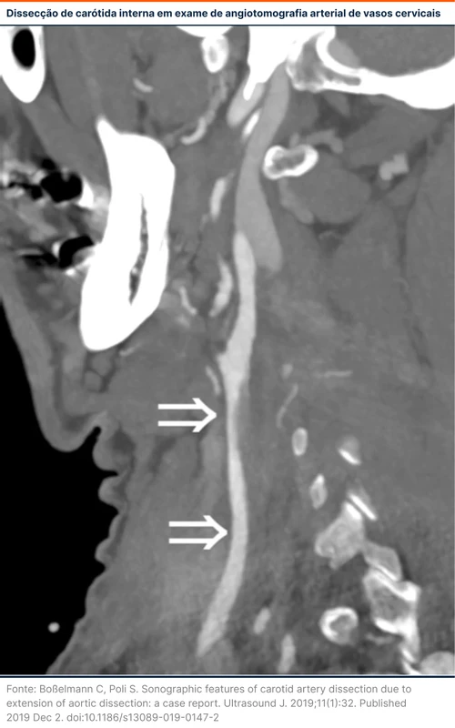 Dissecção de carótida interna em exame de angiotomografia arterial de vasos cervicais