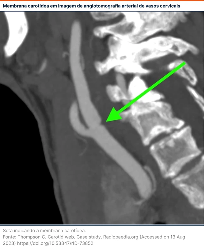 Membrana carotídea em imagem de angiotomografia arterial de vasos cervicais