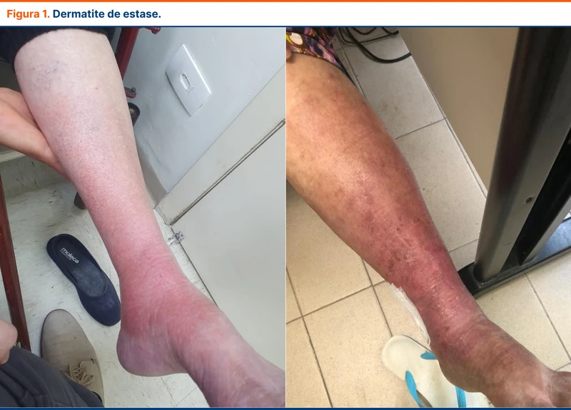 Dermatite de estase