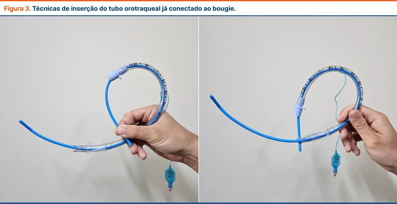 Técnicas de inserção do tubo orotraqueal já conectado ao bougie