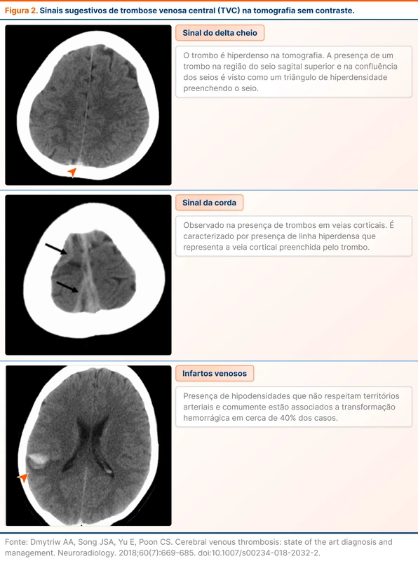 Sinais sugestivos de trombose venosa central (TVC) na tomografia sem contraste