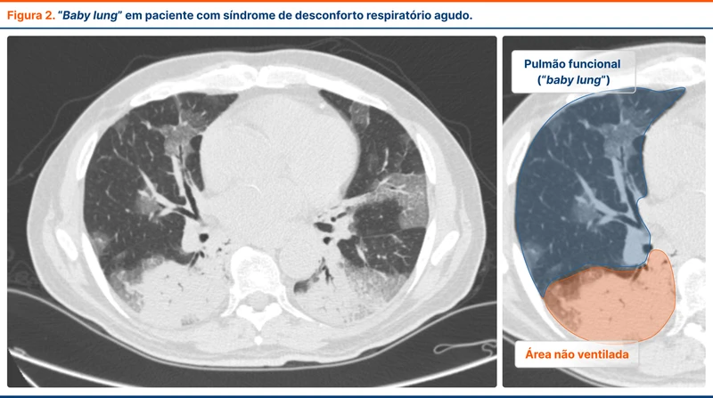 “Baby lung” em paciente com síndrome de desconforto respiratório agudo