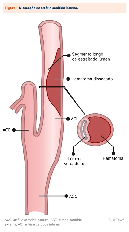 Dissecção da artéria carótida interna