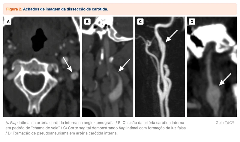 Achados de imagem da dissecção de carótida