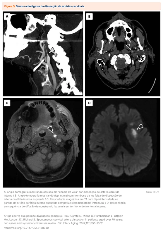 Sinais radiológicos da dissecção de artérias cervicais