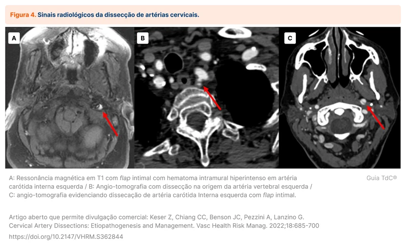 Sinais radiológicos da dissecção de artérias cervicais