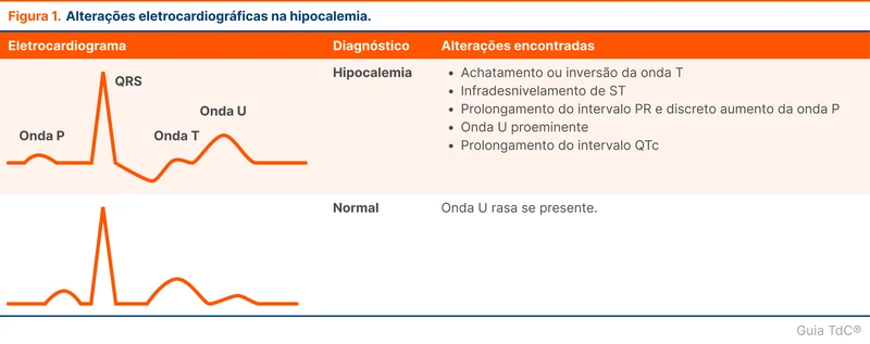 Alterações eletrocardiográficas na hipocalemia.