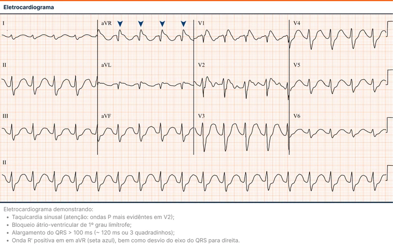 Eletrocardiograma