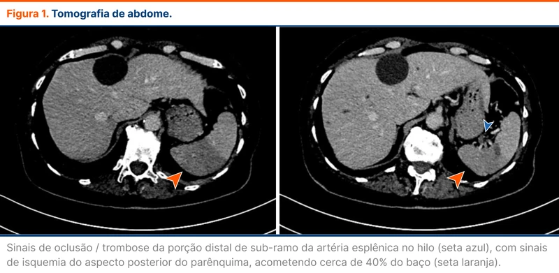 Tomografia de abdome