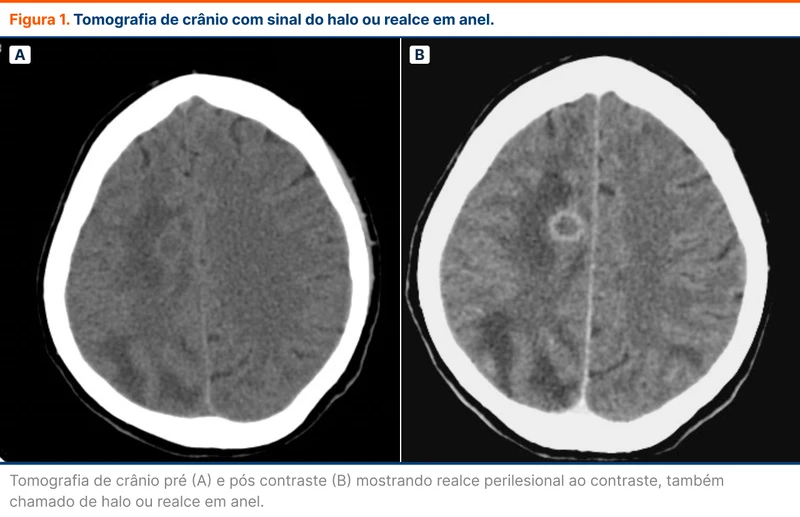 Tomografia de crânio com sinal do halo ou realce em anel