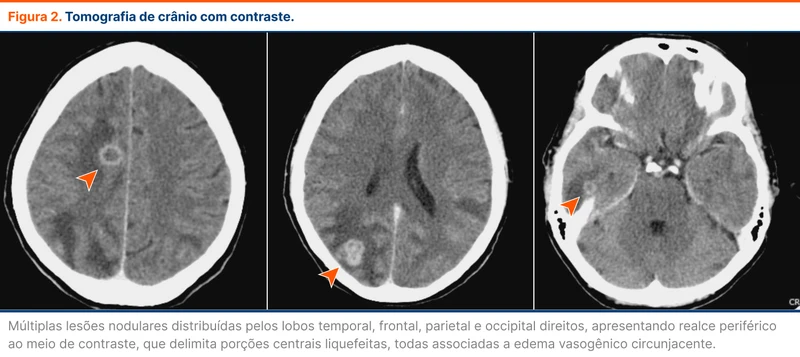 Tomografia de crânio com contraste