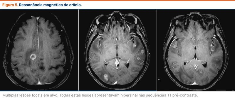 Ressonância magnética de crânio