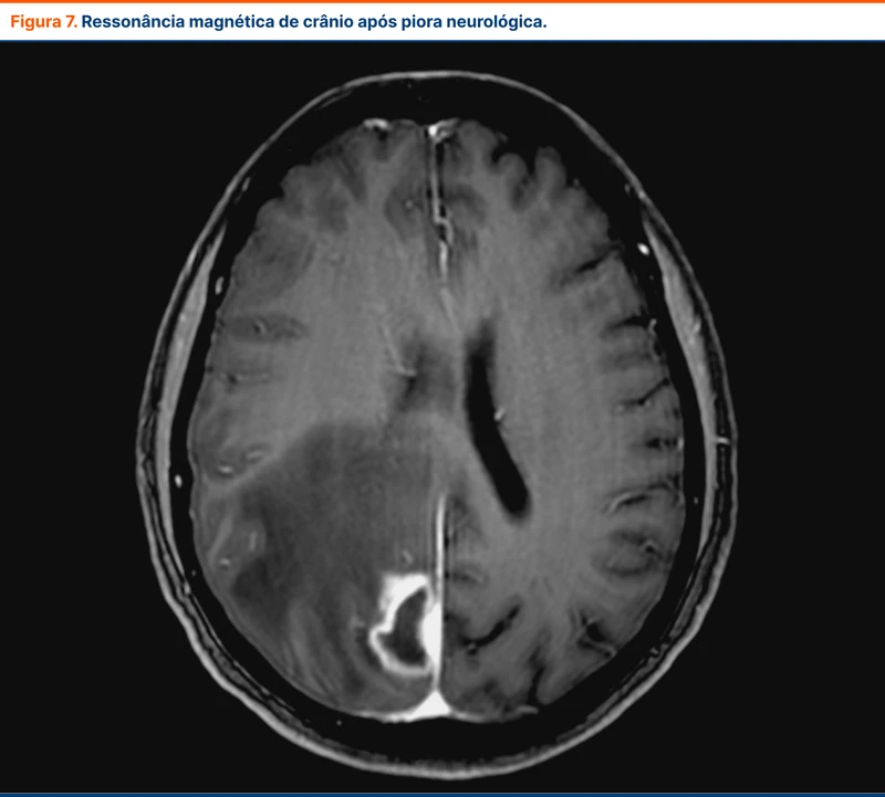 Ressonância magnética de crânio após piora neurológica