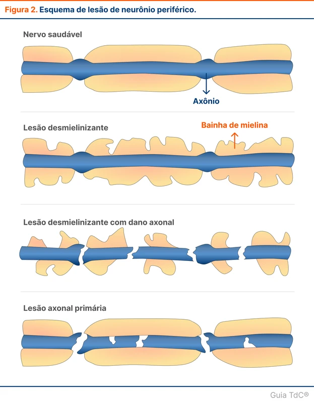 Esquema de lesão de neurônio periférico