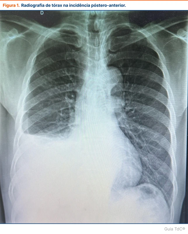 Radiografia de tórax na incidência póstero-anterior.