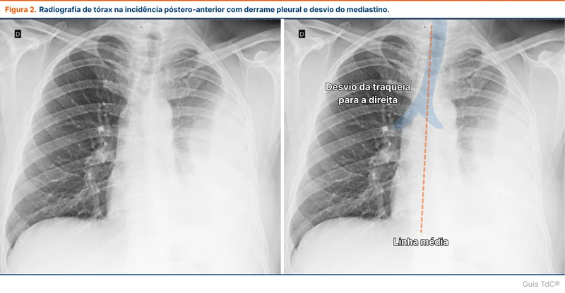 Radiografia de tórax na incidência póstero-anterior com derrame pleural e desvio do mediastino.