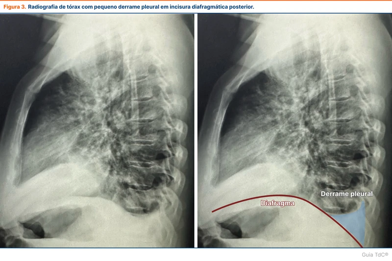 Radiografia de tórax com pequeno derrame pleural em incisura diafragmática posterior.