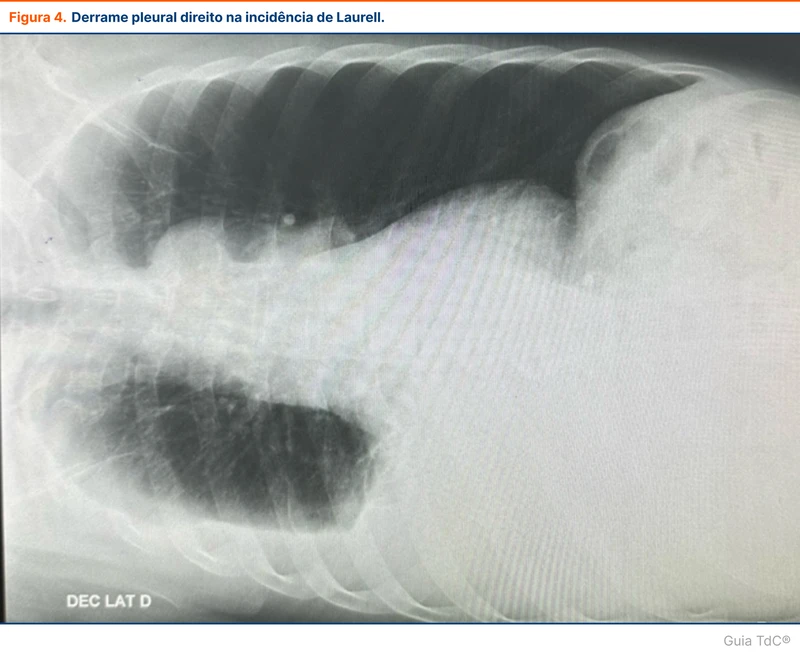 Derrame pleural direito na incidência de Laurell.