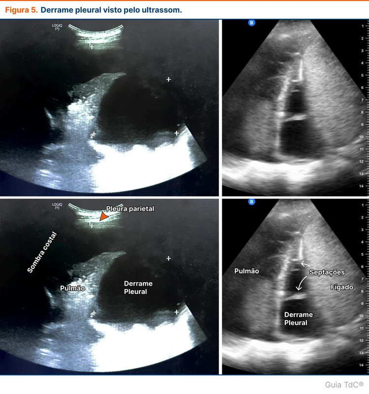 Derrame pleural visto pelo ultrassom.