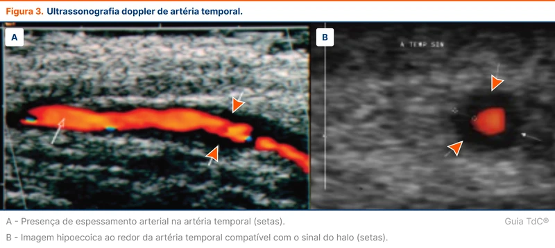 Ultrassonografia doppler de artéria temporal