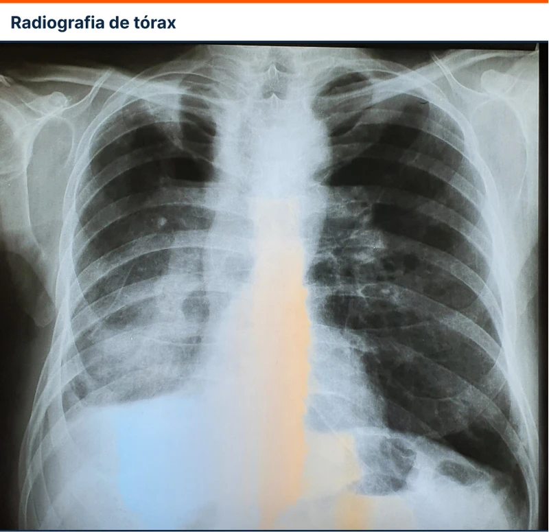 Radiografia de tórax