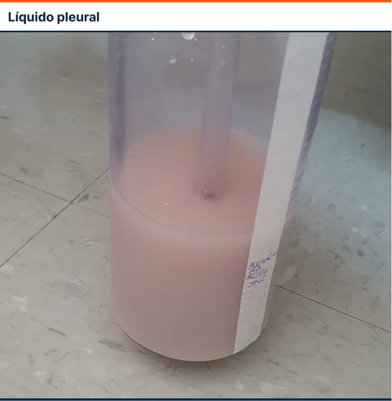 Líquido pleural