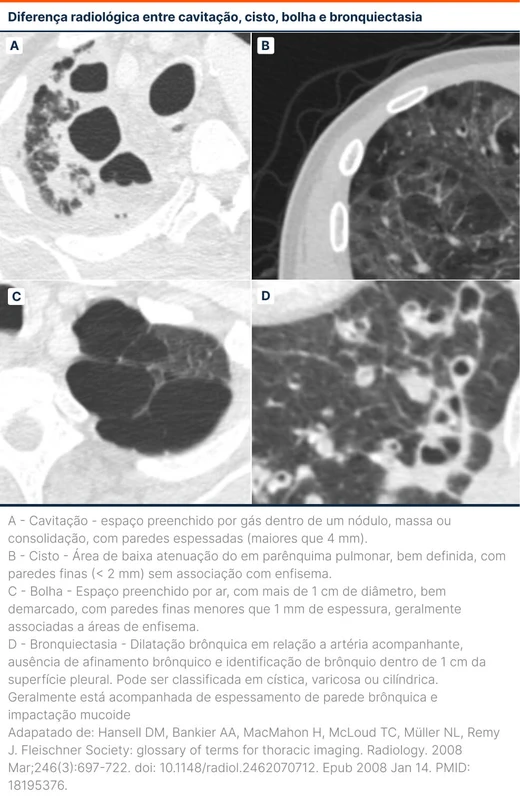 Diferença radiológica entre cavitação, cisto, bolha e bronquiectasia