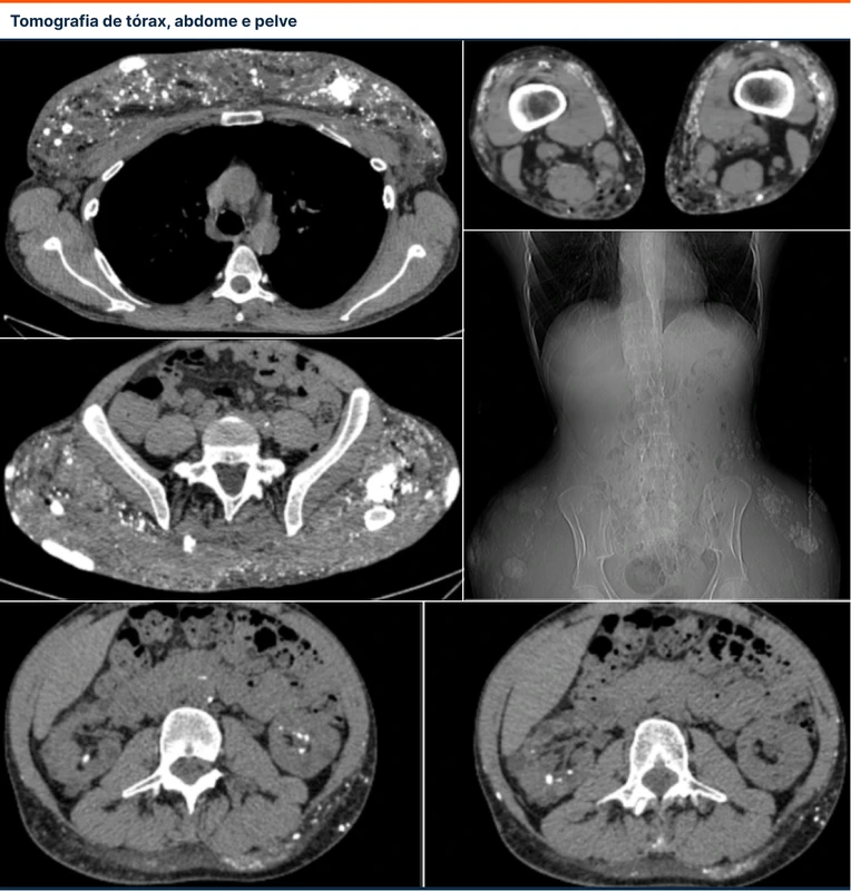 Tomografia de tórax, abdome e pelve