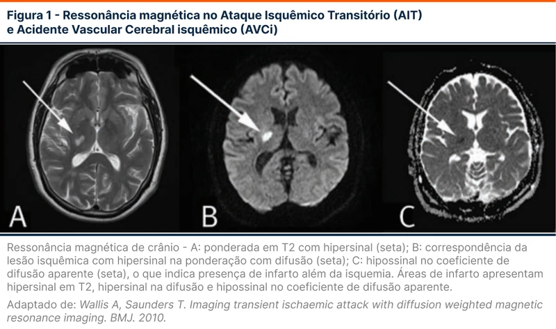 Ressonância magnética no Ataque Isquêmico Transitório (AIT) e Acidente Vascular Cerebral isquêmico (AVCi)