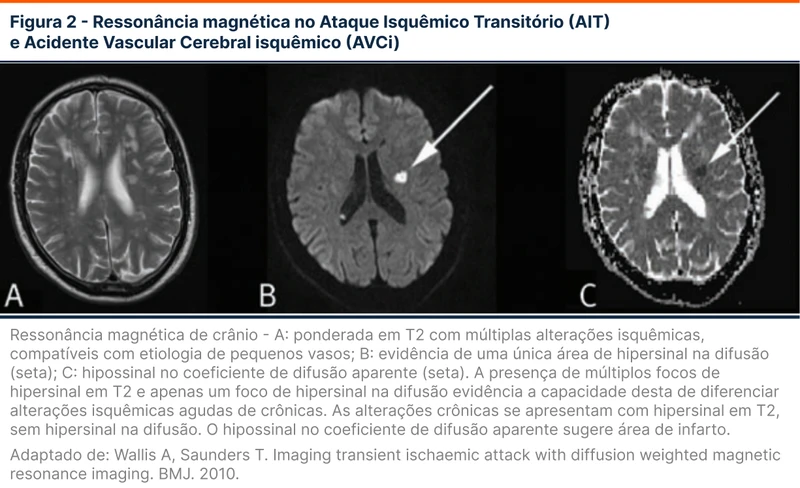 Ressonância magnética no Ataque Isquêmico Transitório (AIT) e Acidente Vascular Cerebral isquêmico (AVCi)