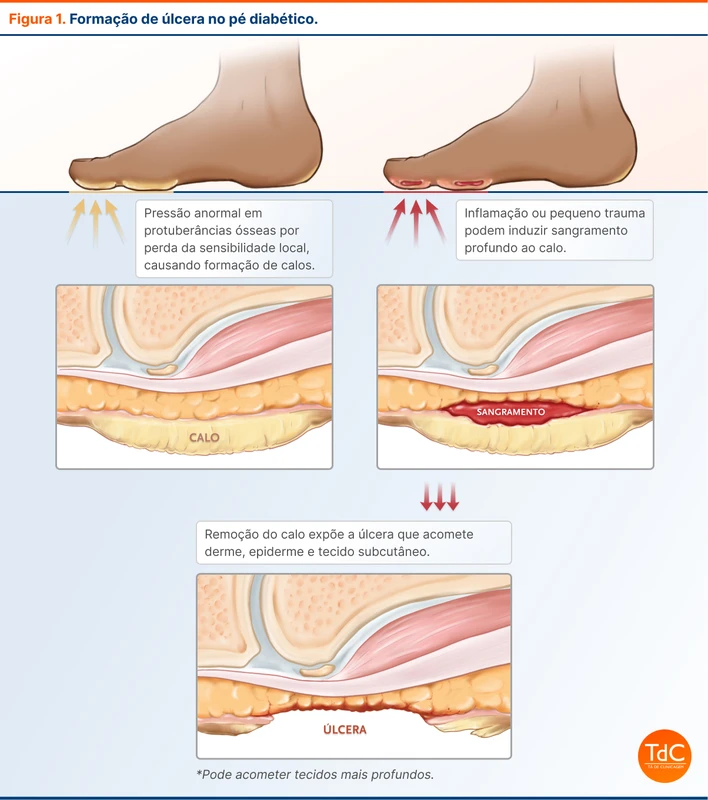 Formação de úlcera no pé diabético