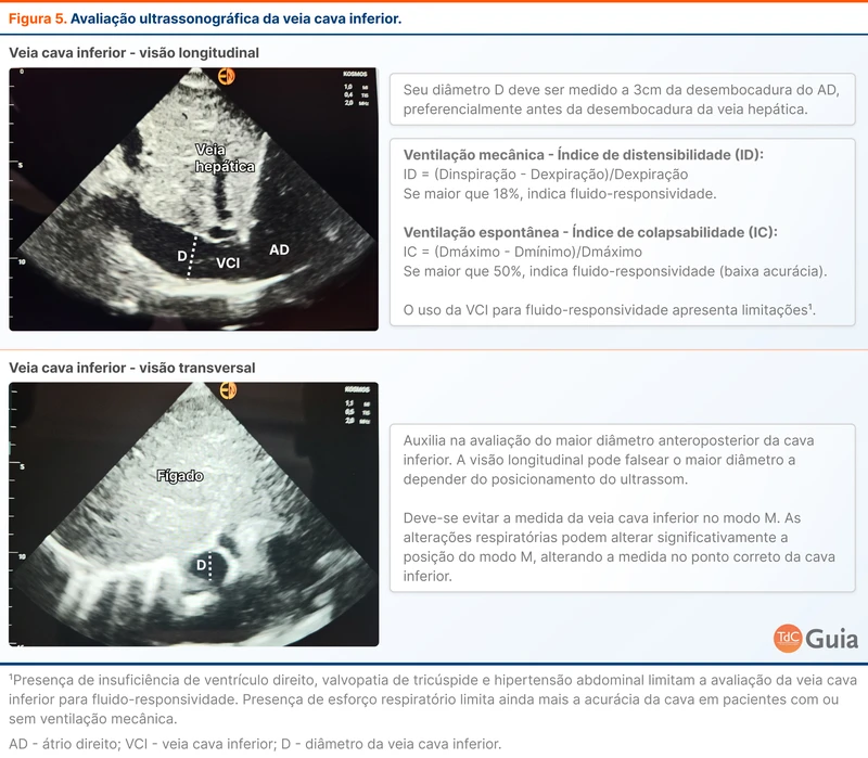 Avaliação ultrassonográfica da veia cava inferior
