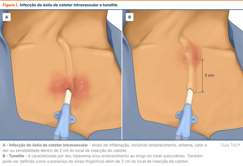 Infecção de óstio de cateter intravascular e tunelite