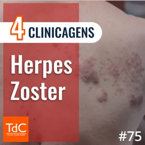 Episódio 75: 4 Clinicagens sobre Herpes Zoster